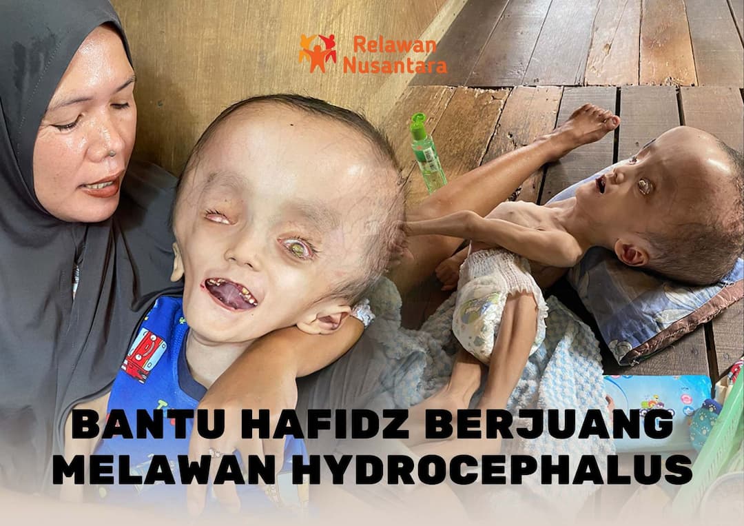 Bantu Kebutuhan Hafidz Melawan Hidrosefalus
